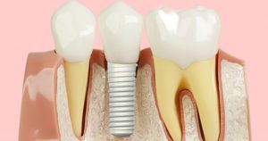 implantes dentários londrina