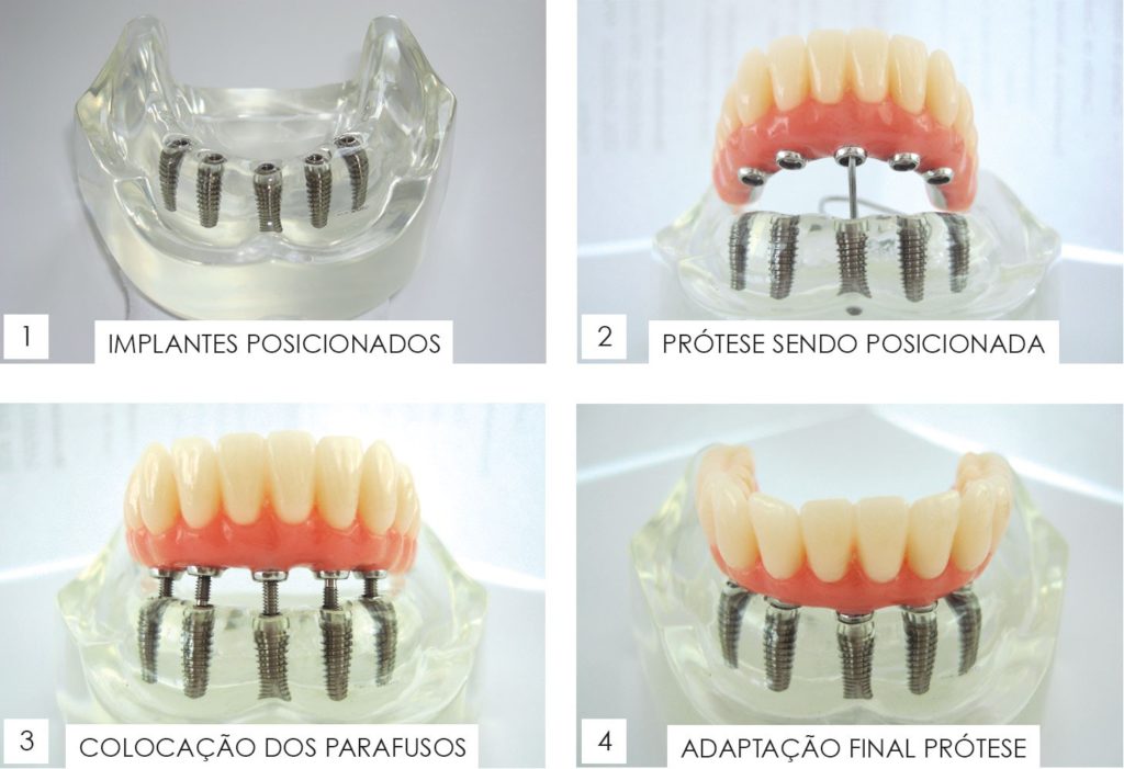 implantes dentarios londrina