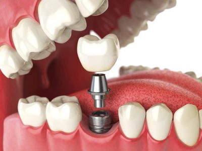 o-que-e-implante-dentario-1024x675